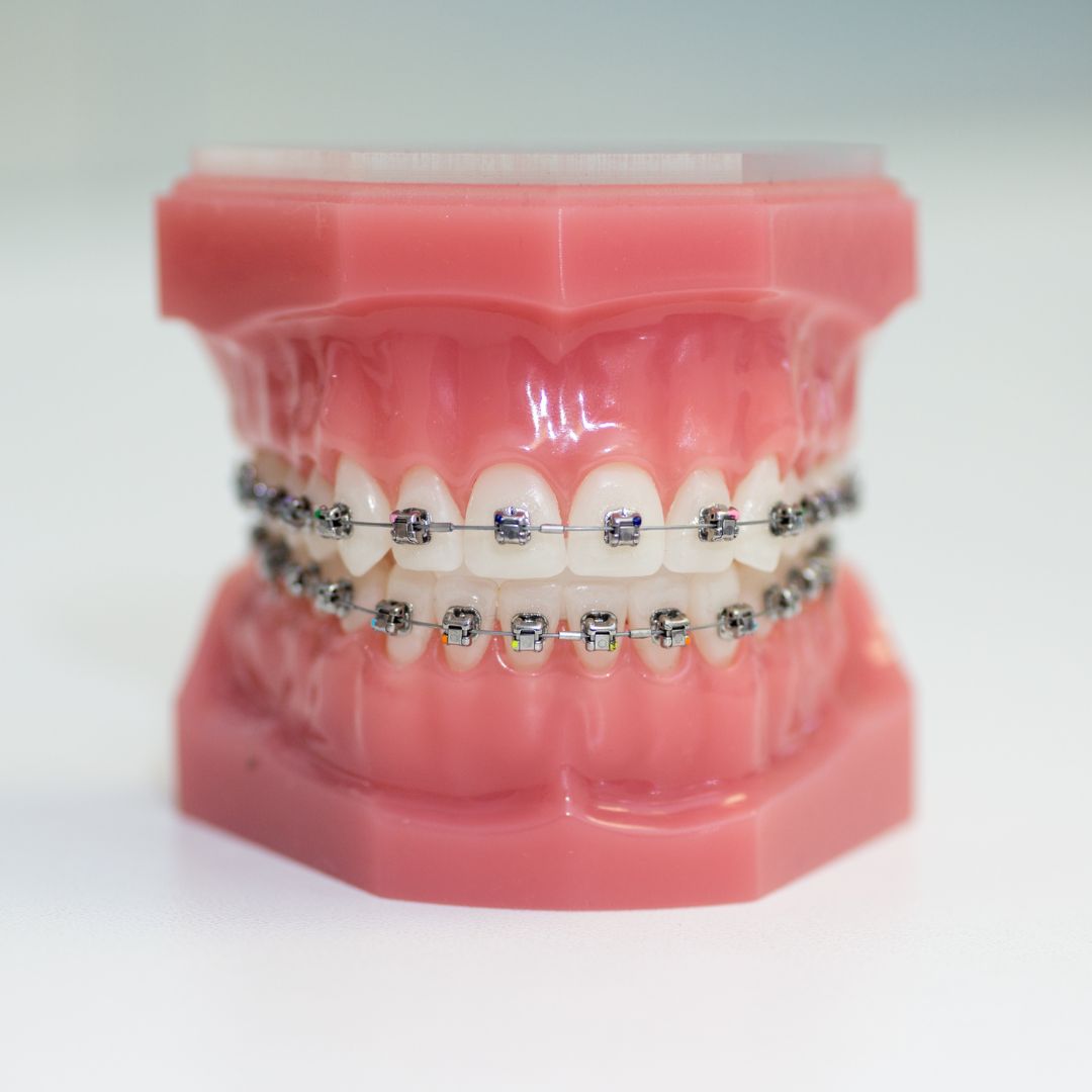 Dental braces for teens