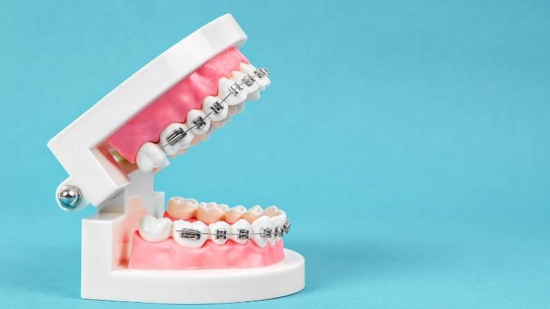 Dental braces for teens