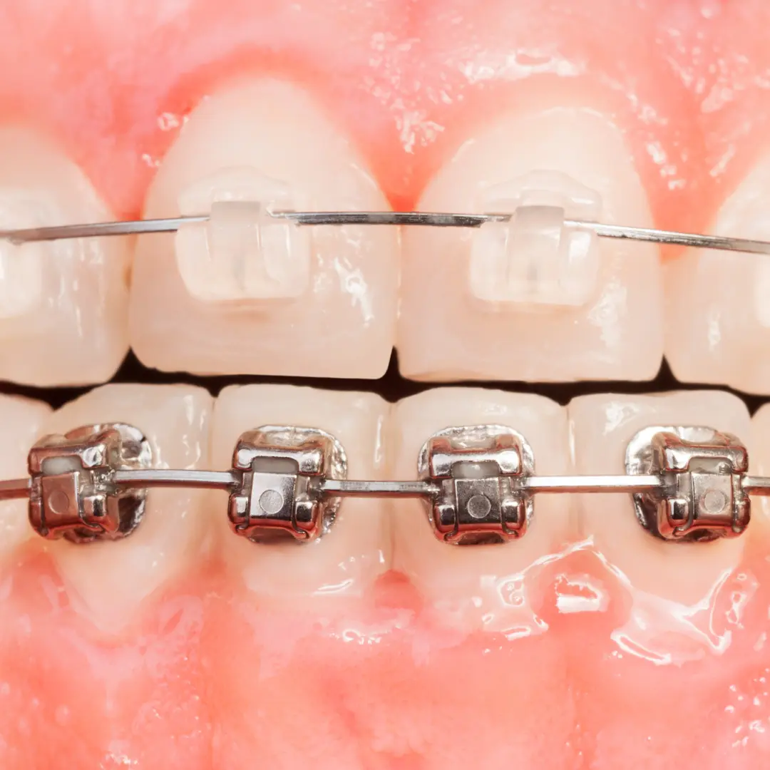 Clear braces vs metal