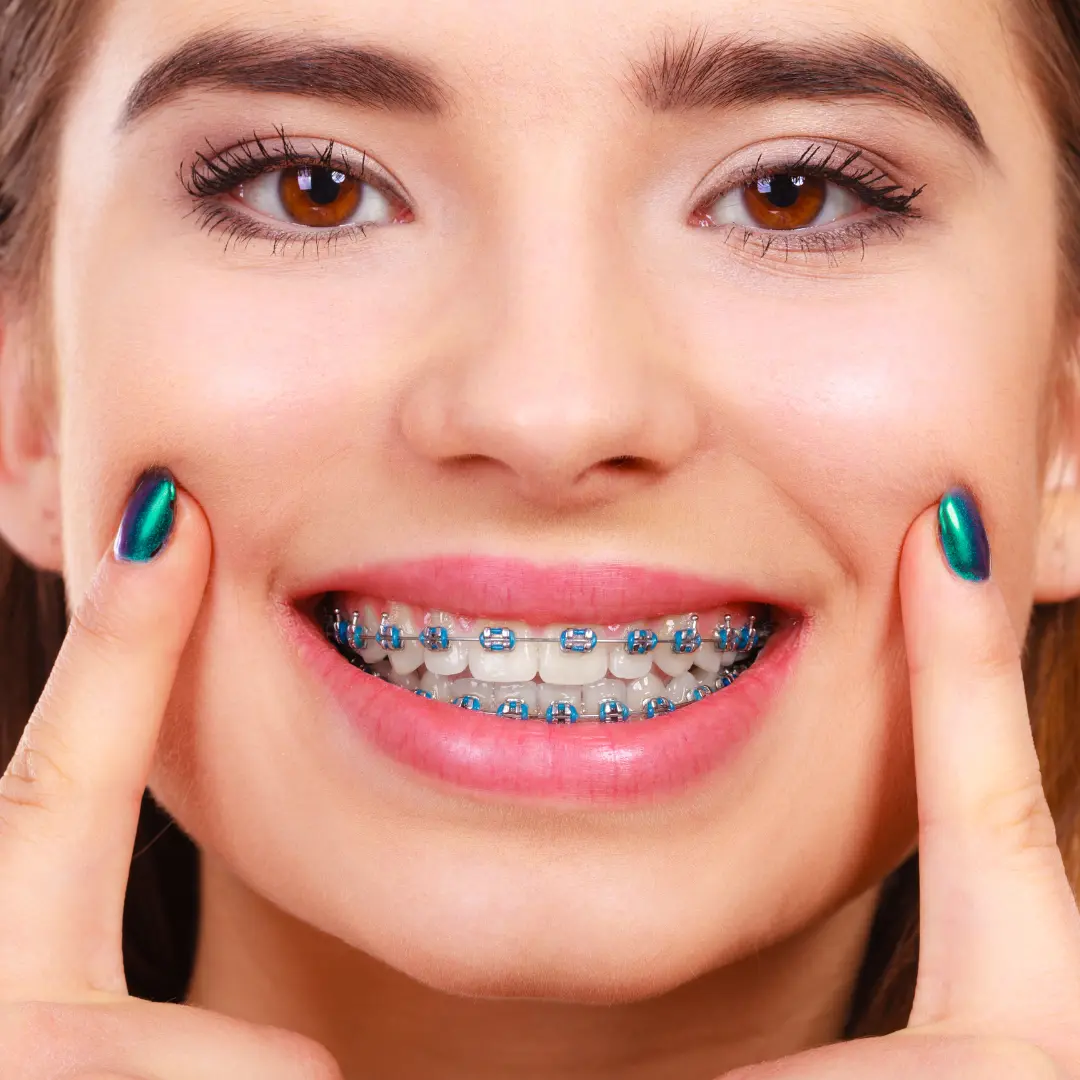 Color braces for teeth