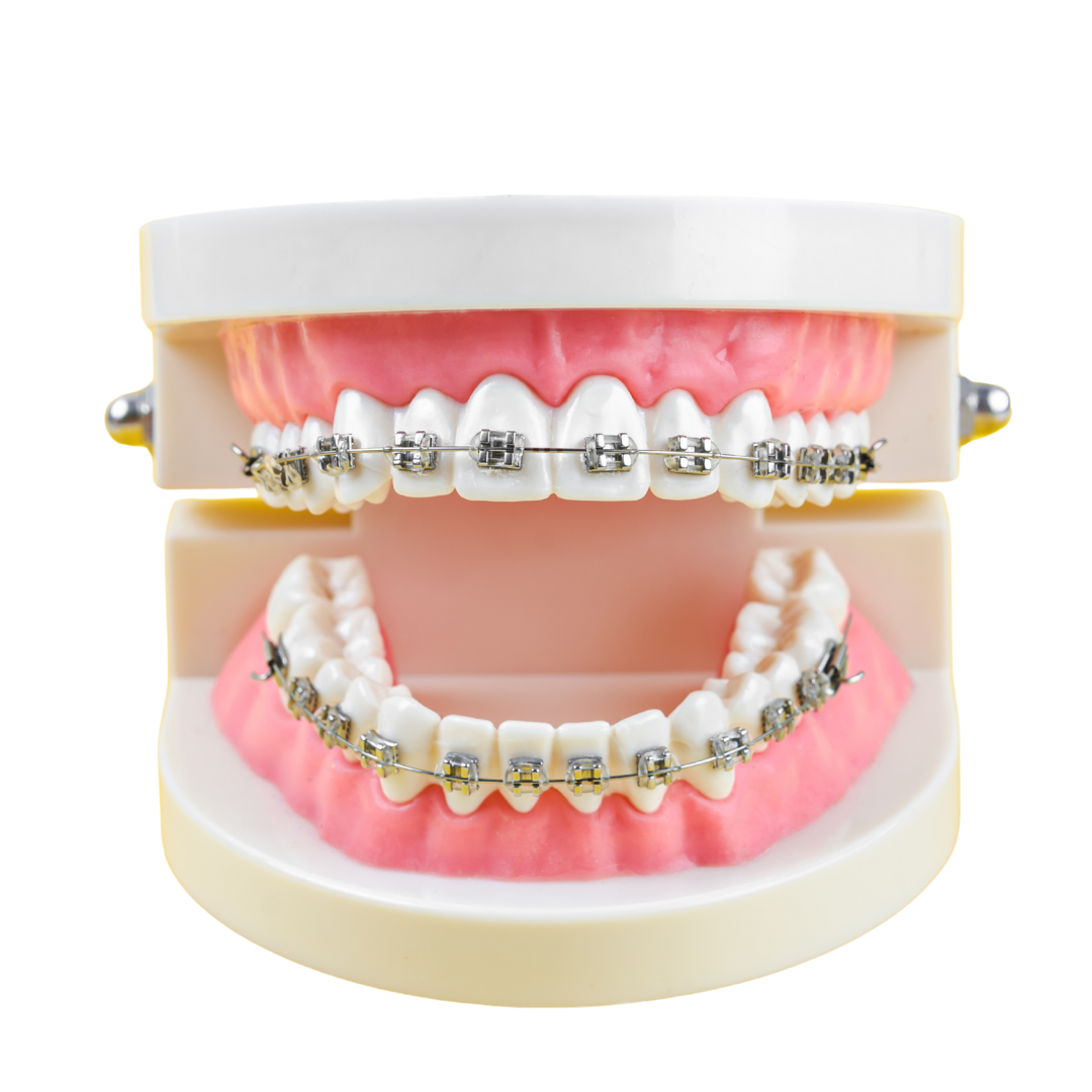Braces vs lingual braces cost